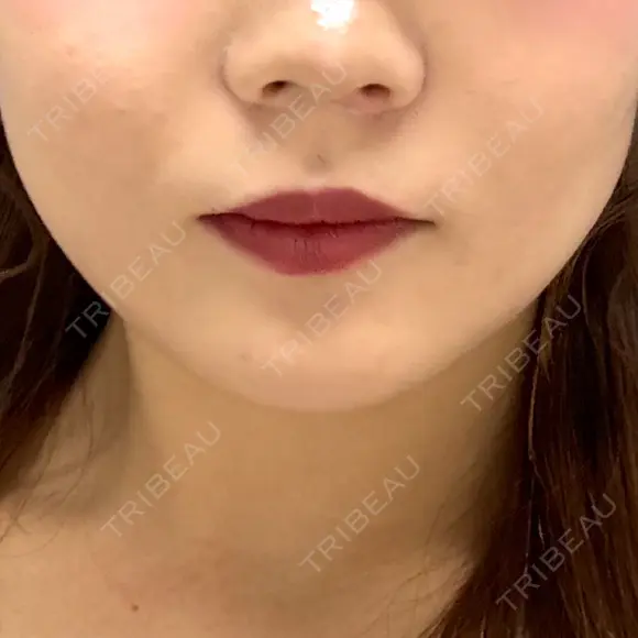 ボトックス（エラ・小顔） 形成外科と美容外科のクリニック池袋 BEFORE メイン用