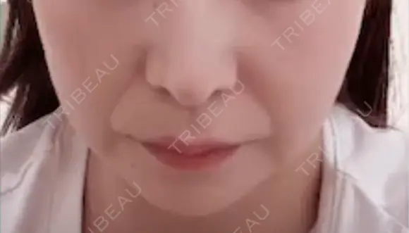 肌ヒアルロン酸注入（たるみ・シワ改善） DMTC美容皮膚科 大宮院 BEFORE メイン用