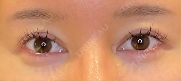 目尻切開 / タレ目形成・グラマラスライン（埋没） / ヒアルロン酸注入（涙袋） / ボトックス（口角） LOUIS CLINIC 二子玉川院【ルイクリニック】 BEFORE メイン用