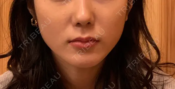 ボトックス（エラ・小顔） TCB東京中央美容外科 池袋西口院 BEFORE メイン用