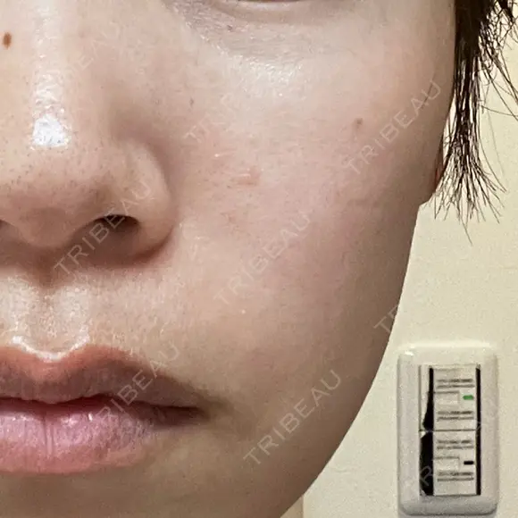 ピーリング（ニキビ・毛穴） / 光治療（フォトフェイシャルなど） RAISE CLINIC 【レイズクリニック】 BEFORE メイン用