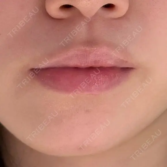 ヒアルロン酸注入（あご） / ヒアルロン酸注入（唇） / ボトックス（口角） ルラ美容クリニック 大阪本院 BEFORE メイン用