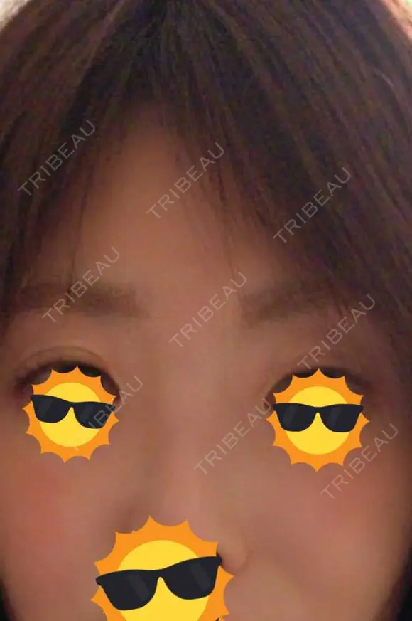 二重埋没 / 眉下切開 ネビュラクリニック 京都院 BEFORE メイン用
