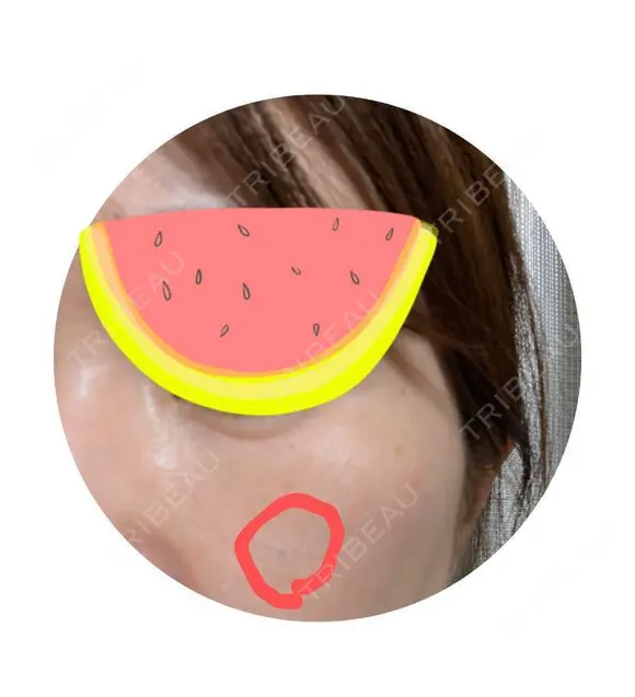 その他（肌） スマートスキンクリニック 神保町院 BEFORE メイン用