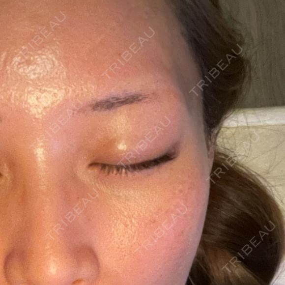 ダーマペン LIFIX BEAUTY CLINIC BEFORE メイン用