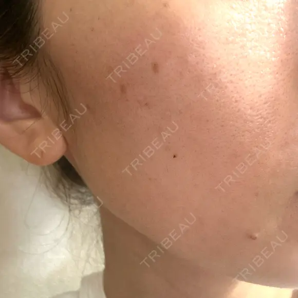 ルメッカ ルラ美容クリニック 名古屋栄院 / ルラスキンクリニック 名古屋栄院 BEFORE メイン用