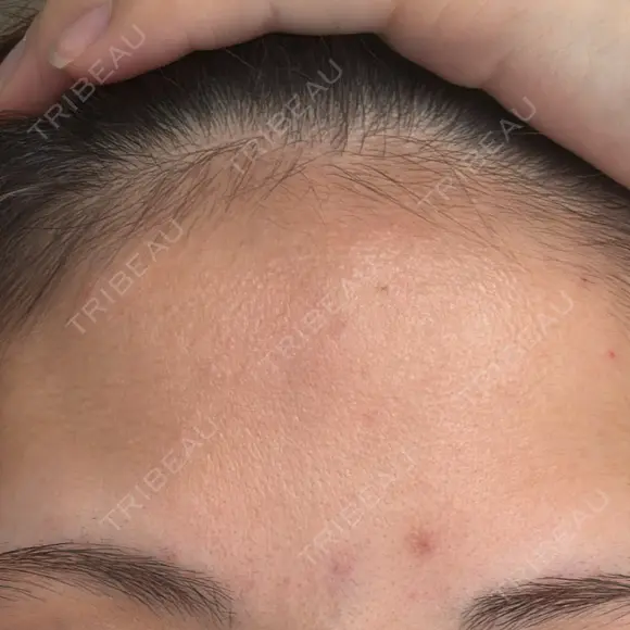 シワ取りボトックス / ボトックス（眉間） / ボトックス（額） TCB東京中央美容外科 名古屋栄院 BEFORE メイン用