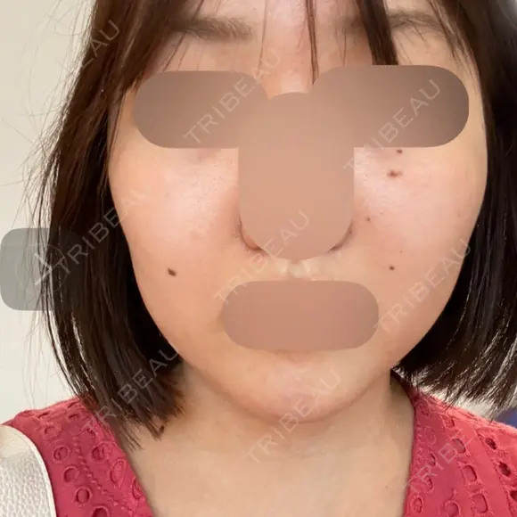 RF（高周波）たるみ治療 ルラ美容クリニック 福岡本院 BEFORE メイン用