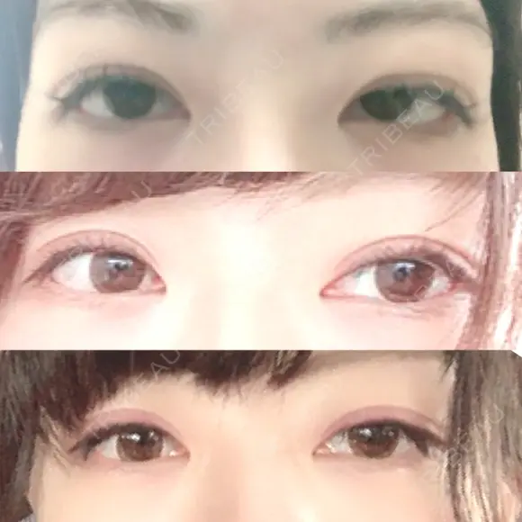 眼瞼下垂（切開） 札幌中央形成外科 BEFORE メイン用
