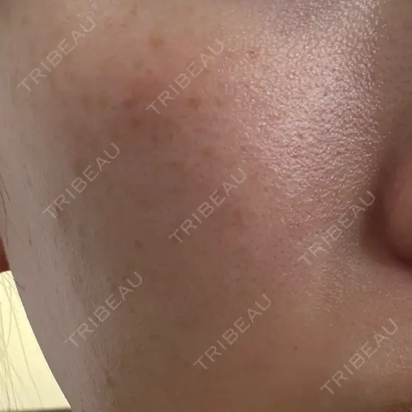 フォトRF 共立美容外科 仙台院 BEFORE メイン用