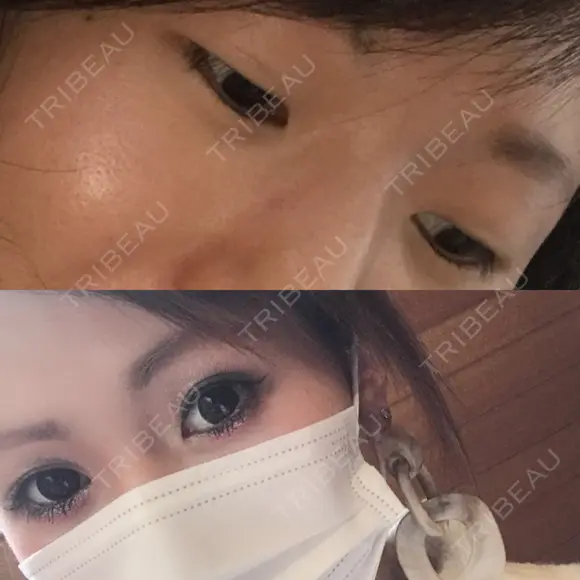 二重埋没 城本クリニック 姫路院 BEFORE メイン用