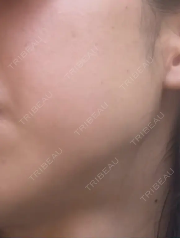 RF（高周波）たるみ治療 ルラ美容クリニック 札幌本院 BEFORE メイン用