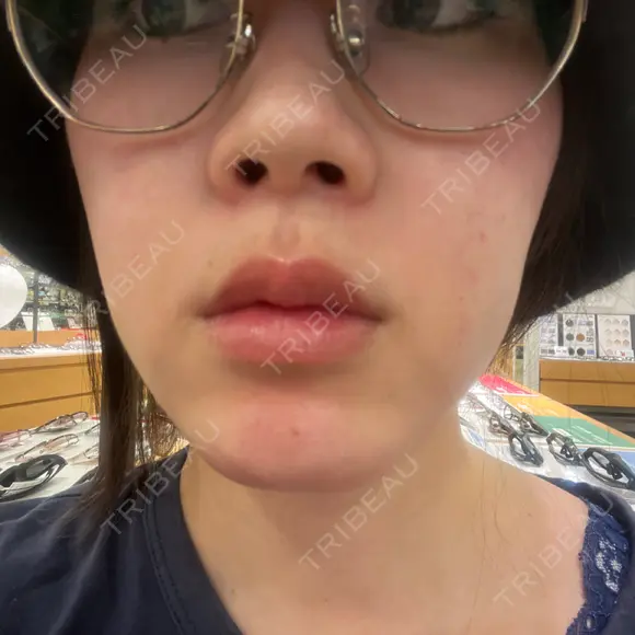 医療脱毛（顔） 共立美容外科 立川院 BEFORE メイン用