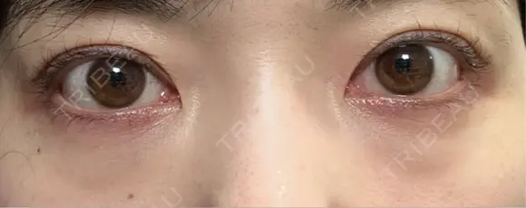 クマ治療 / 下まぶたたるみ取り / 下まぶたの脂肪取り / 脂肪注入（目の下） / ボトックス（あご） / ボトックス（眉間） お茶の水美容形成クリニック BEFORE メイン用