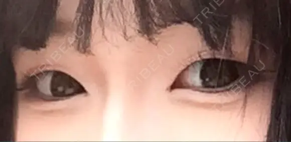 二重埋没 品川美容外科 仙台院 BEFORE メイン用