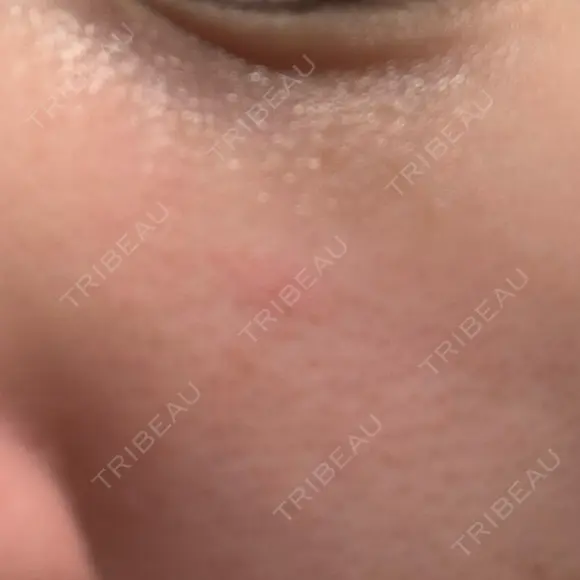 リジュラン 小木曽クリニック BEFORE メイン用