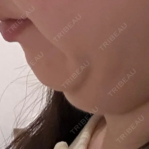 糸リフト / 脂肪吸引（顔） / 脂肪吸引（二の腕） / 脂肪吸引（脚） / 脂肪吸引（お腹） / 脂肪吸引（お尻） / 脂肪吸引（腰） / 脂肪吸引（背中） / 脂肪吸引（肩） ヴェルトラクリニック 新宿院 BEFORE メイン用