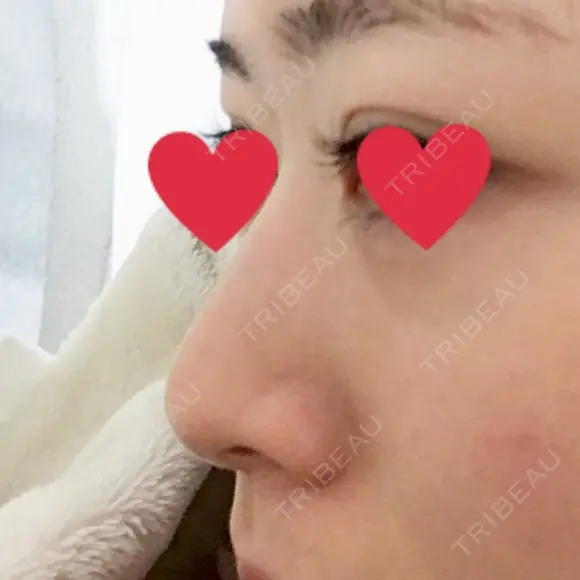 隆鼻術 / 鼻尖形成（切開） / 鼻中隔延長（切開） / 斜鼻修正 / 眉間プロテーゼ / その他（鼻） FROM B整形外科 (旧バウム整形外科) BEFORE メイン用