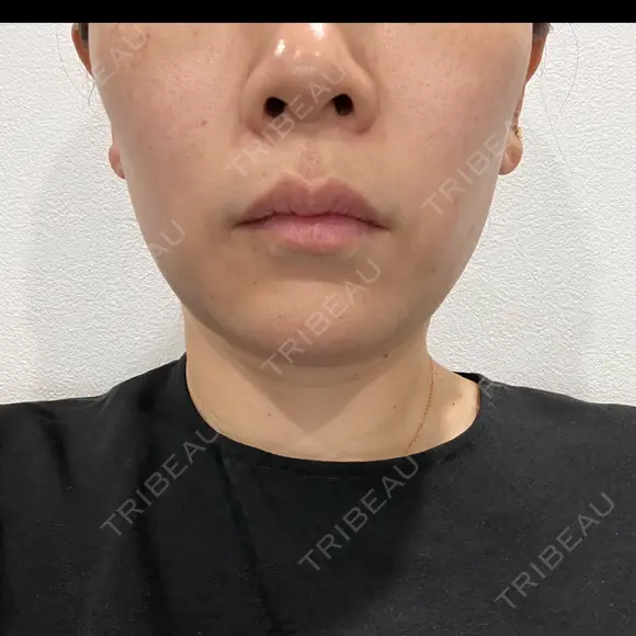 脂肪溶解注射（顔） / プラズマ治療 LE CLINIC BEFORE メイン用