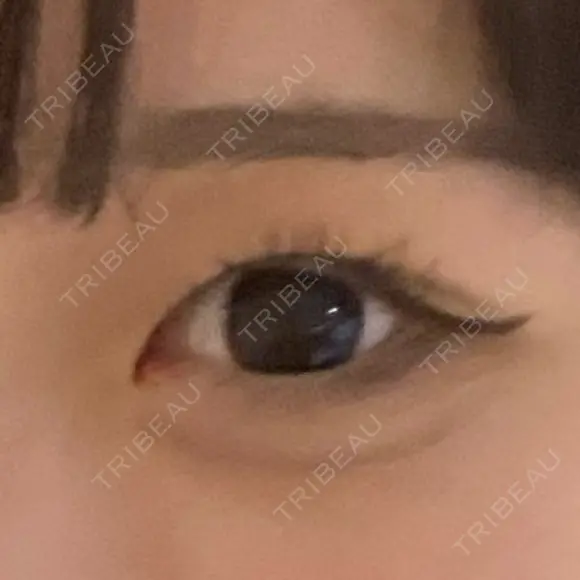 二重切開 / 眼瞼下垂（切開） EMMO FACE CLINIC 東京三田院 BEFORE メイン用