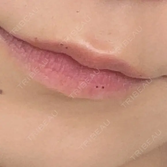 ヒアルロン酸注入（涙袋） / ヒアルロン酸注入（唇） PRO CLINIC プロクリニック 銀座院 BEFORE メイン用