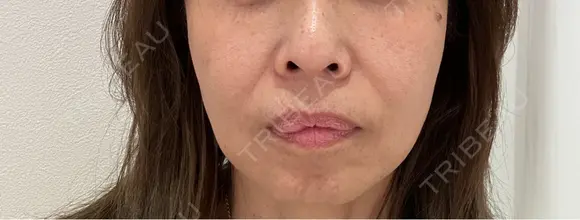 ショッピングリフト Natural Skin Clinic 笹塚院 BEFORE メイン用