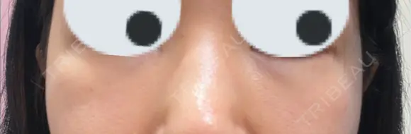 ヒアルロン酸溶解 小木曽クリニック BEFORE メイン用