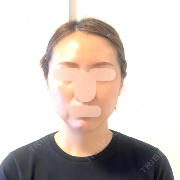 脂肪吸引（顔） / ボトックス（エラ・小顔） Mods Clinic（モッズクリニック） 東京院 BEFORE メイン用