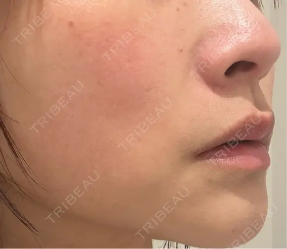 美肌レーザー / 美白レーザー / YAGレーザー / レーザーフェイシャル / 赤み除去レーザー AI Beauty Clinic （エーアイ美容クリニック） BEFORE メイン用