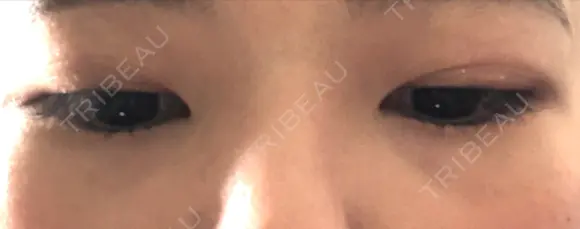 二重埋没 / 下まぶたの脂肪取り / ボトックス（エラ・小顔） 表参道スキンクリニック 表参道院 BEFORE メイン用