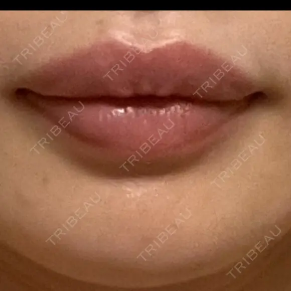 ヒアルロン酸注入（唇） アネシス美容クリニック BEFORE メイン用