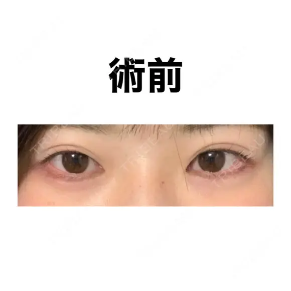 自然癒着法 / 眼瞼下垂（非切開） LUHO（ルホ）美容外科 BEFORE メイン用