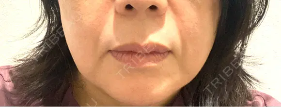ヒアルロン酸注入（鼻翼基部） TCB東京中央美容外科 京都四条院 BEFORE メイン用