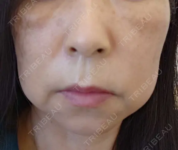 イオン導入 / ピコレーザートーニング（美白・肝斑） / ピコスポット A CLINIC（エークリニック） 横浜院 BEFORE メイン用