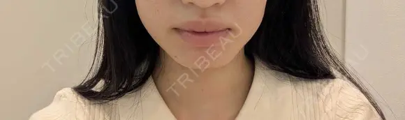 ボトックス（エラ・小顔） / ボトックス（口角） / ボトックス（肩） DMTC CLINIC 日本橋院 BEFORE メイン用