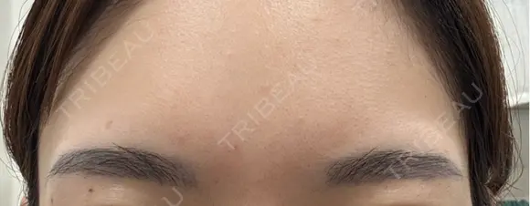 アートメイク除去・修正 しのぶ皮膚科 BEFORE メイン用