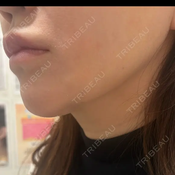 糸リフト / ボトックス（あご） / ヒアルロン酸注入（あご） / RF（高周波）たるみ治療 / ピーリング（ハリ・ツヤ） ルラ美容クリニック 千葉院 / ルラスキンクリニック 千葉院 BEFORE メイン用