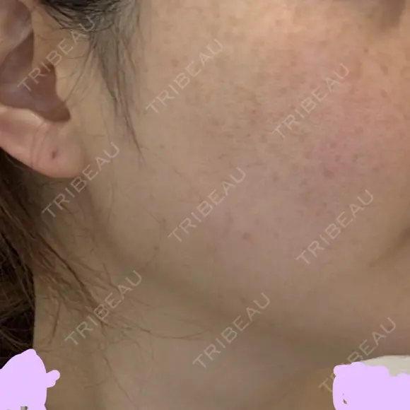 光治療（フォトフェイシャルなど） ルラ美容クリニック 札幌本院 BEFORE メイン用