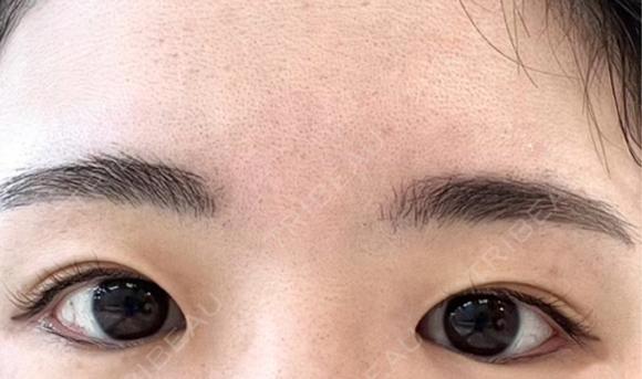 二重埋没 OMI CLINIC 【オミクリニック】 BEFORE メイン用