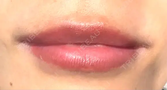 ヒアルロン酸注入（唇） Wi Clinic （ウィ クリニック）心斎橋院 BEFORE メイン用