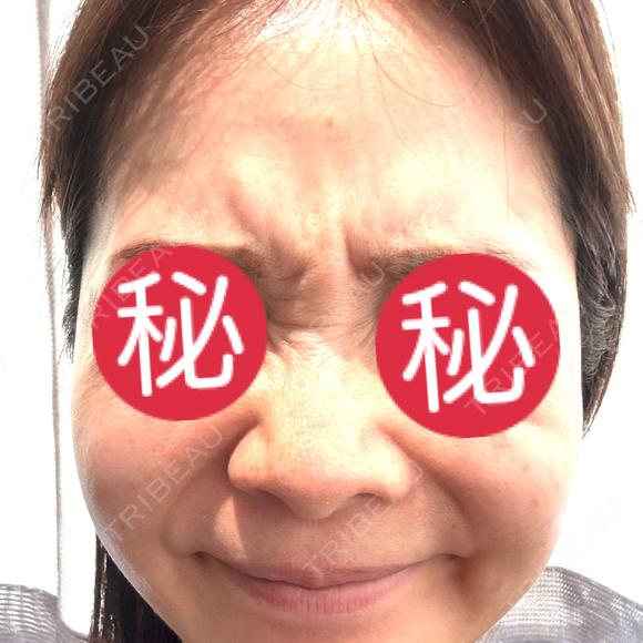 シワ取りボトックス / ボトックス（眉間） / ボトックス（額） / その他（肌） 湘南美容クリニック 大阪四ツ橋院 BEFORE メイン用
