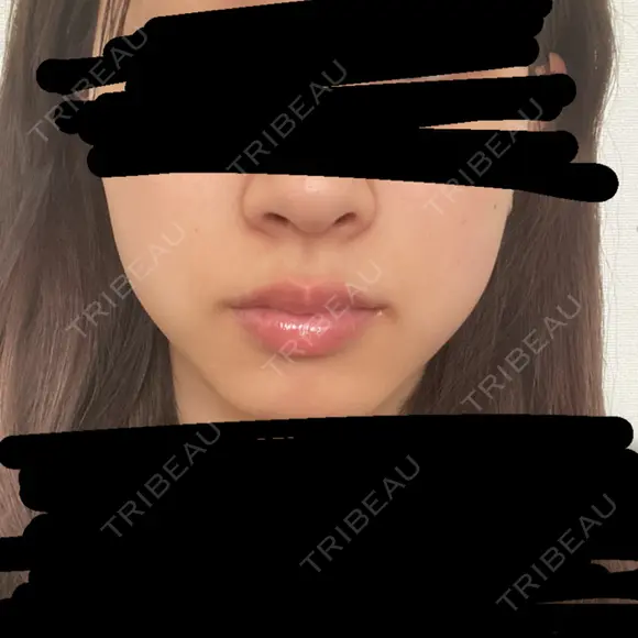 ボトックス（エラ・小顔） TCB東京中央美容外科 天王寺院 BEFORE メイン用