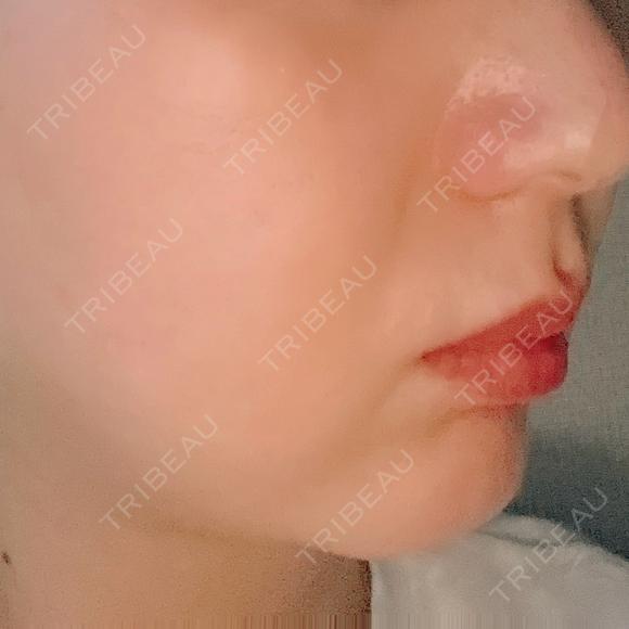 RF（高周波）たるみ治療 PureMe Skin Clinic（ピュアミースキンクリニック麻布） BEFORE メイン用