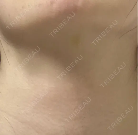 ボトックス（首） PRO CLINIC プロクリニック 銀座院 BEFORE メイン用