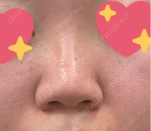 隆鼻術 / 鼻尖縮小 サラ美容外科 BEFORE メイン用