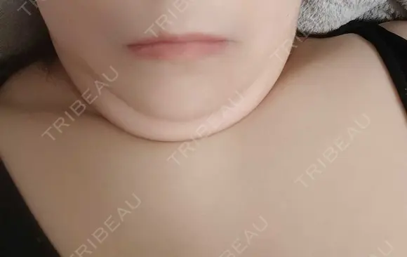 糸リフト / 脂肪吸引注射（顔） EMMO FACE CLINIC 大阪梅田院 BEFORE メイン用
