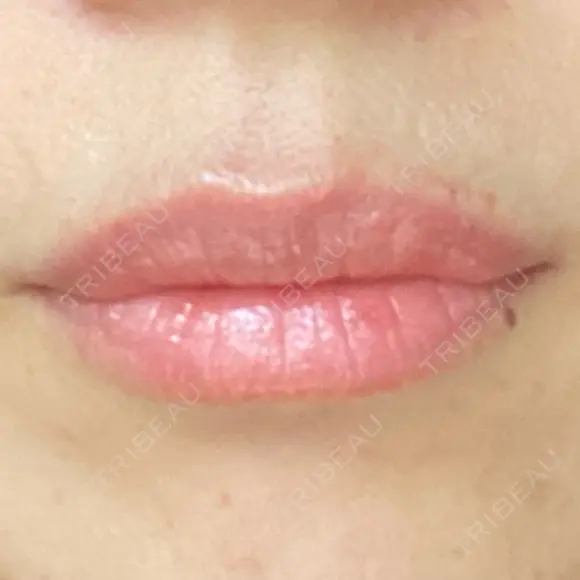 ヒアルロン酸注入（唇） アネシス美容クリニック BEFORE メイン用