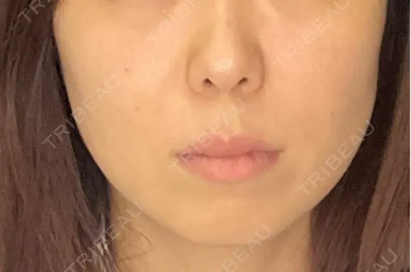 RF（高周波）たるみ治療 CZEN CLINIC 銀座院 BEFORE メイン用