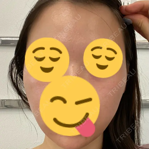 医療脱毛（顔） / ルメッカ 栄美容クリニック 栄院 BEFORE メイン用