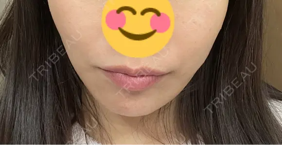 ヒアルロン酸注入（唇） ルラ美容クリニック 岐阜院 BEFORE メイン用
